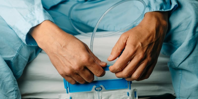 Man holding a urine bag, indicating a possible urine leak around the catheter.